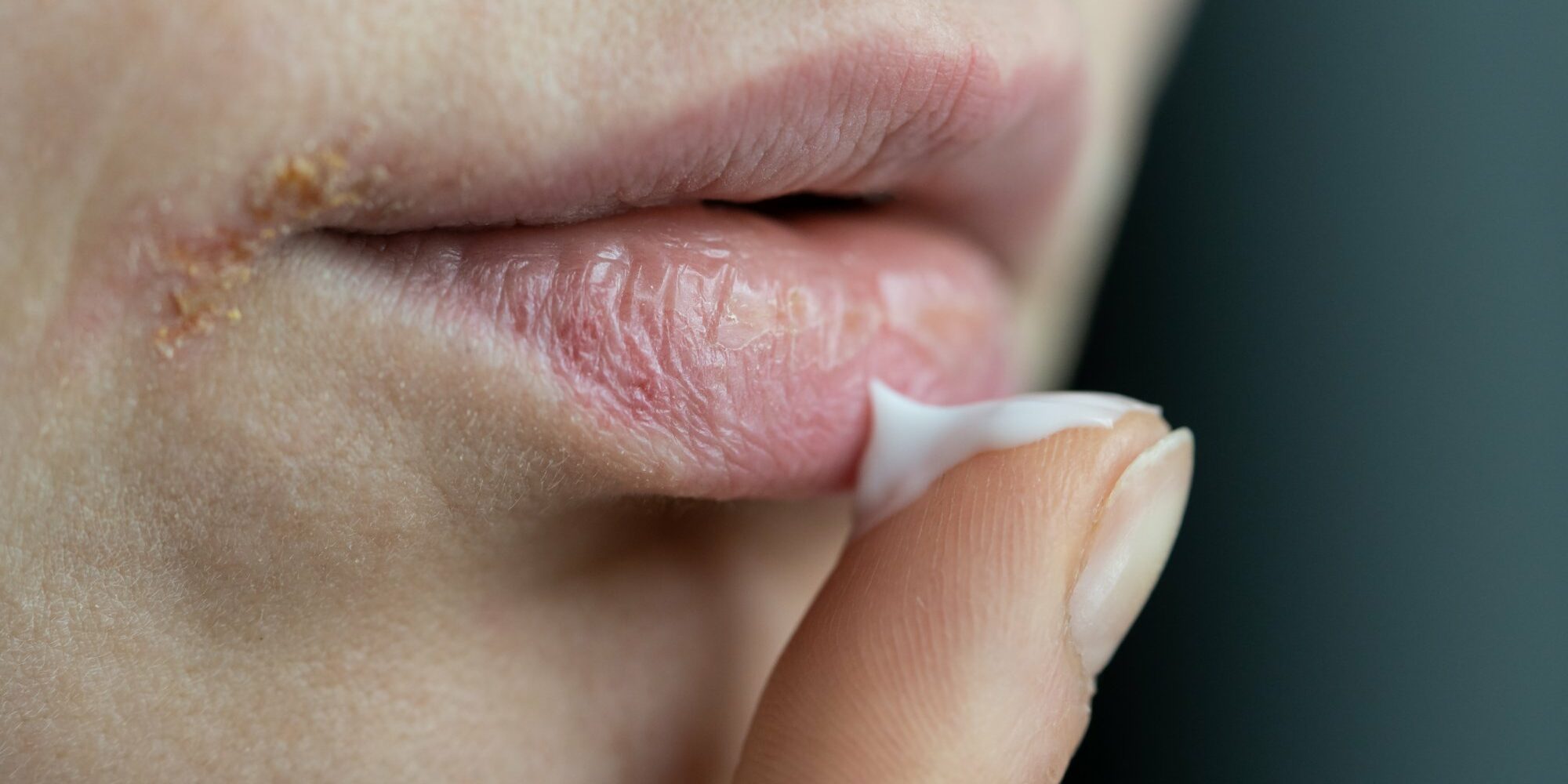 fieberblasen.jpg Eine Hand trägt Lippenpflege auf spröde Lippen auf, sichtbar sind trockene Hautstellen.